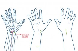 Illustraties handaandoeningen